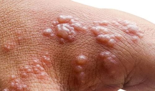 थप एक नेपालीमा मङ्किपक्स पुष्टि